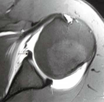 glenoid posterior dysplasia labral mri tears newsletter march posted