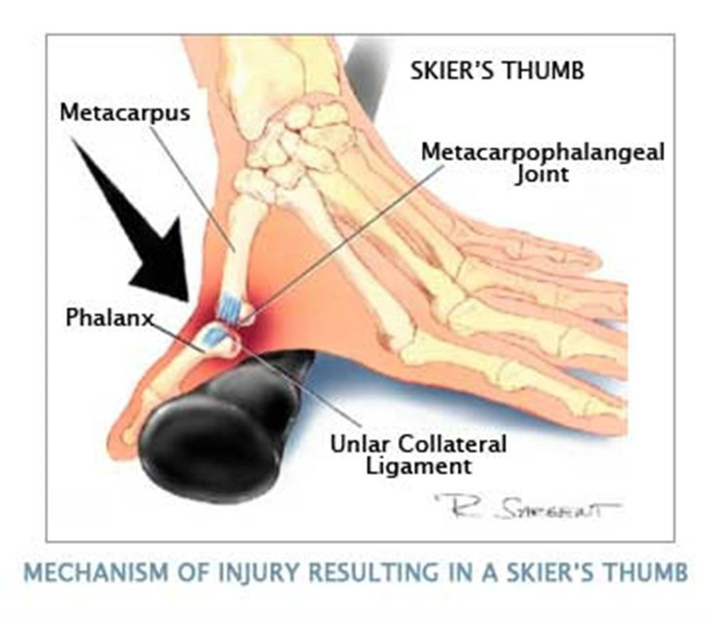 ulnar collateral ligament thumb mri