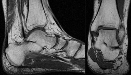 talocalcaneal coalition mri