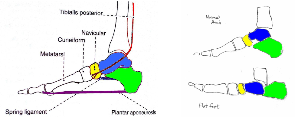 MRI NEWSLETTER: The Spring Ligament, PTT Tear and Adult Acquired ...