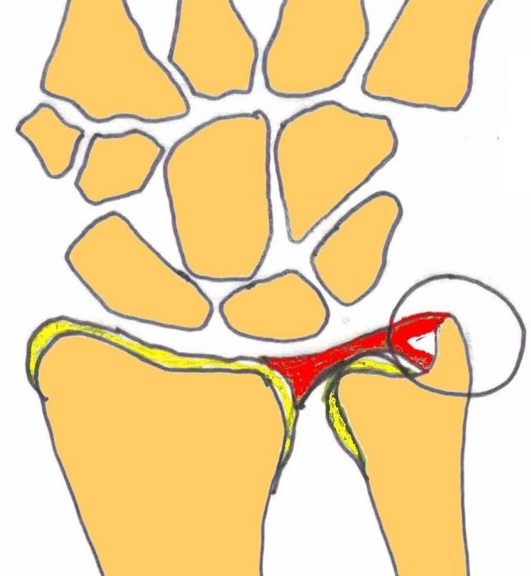 MRI NEWSLETTER Traumatic TFC Tear Radius Imaging